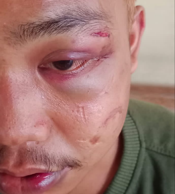Keluarga Laporkan Oknum Polisi atas Dugaan Penganiayaan ODGJ, Kapolres: Kami Sudah Tindaki!